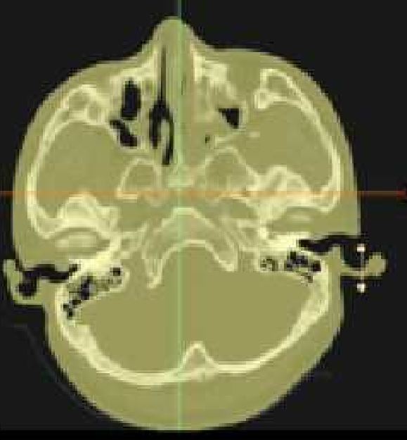 CT Image