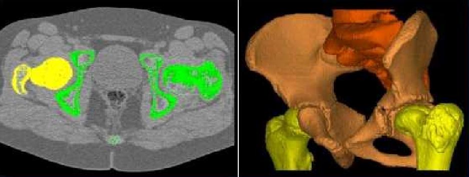 From CT data to bone 3D model