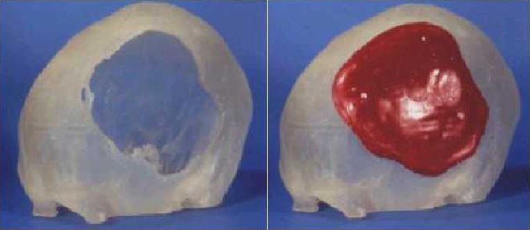 RP model aids in surgical planning